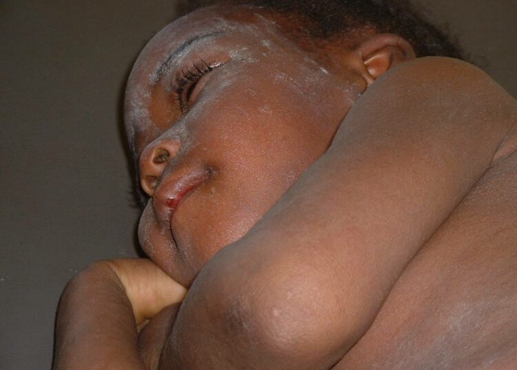 Tuhkarokkoon sairastunut nigerialainen pienokainen.