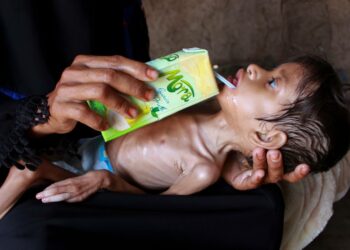 Aliravitsemuksesta kärsii 180 miljoonaa lasta. Kuvassa jemeniläinen 5-vuotias Salva-tyttö.