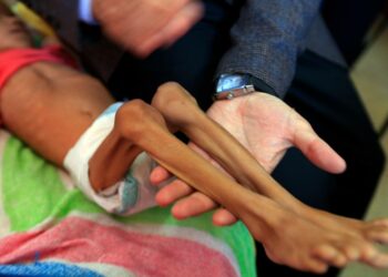 Aliravitsemuksesta kärsivä lapsi Jemenin pääkaupungissa Sanaassa sijaitsevassa sairaalassa.