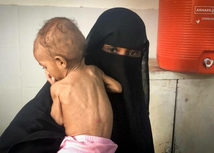 Jemeniläinen Nusair, 11 kk, saa hoitoa Al-Rabassahin aliravitsemusta hoitavalla klinikalla.