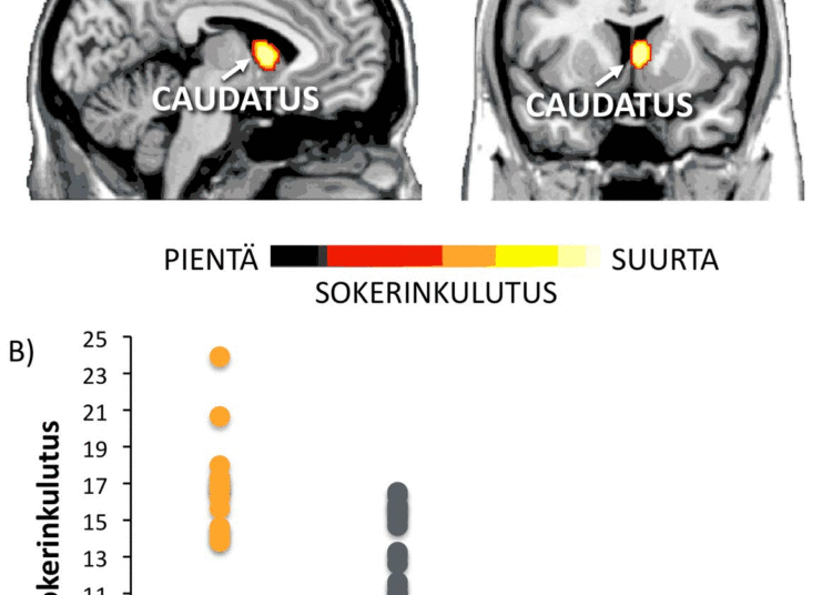 Mielihyvän kokemuksia käsittelevän caudatus-tumakkeen (A)  sokerinkulutus oli merkittävästi suurempaa lihavilla kuin normaalipainoisilla  henkilöillä (B).